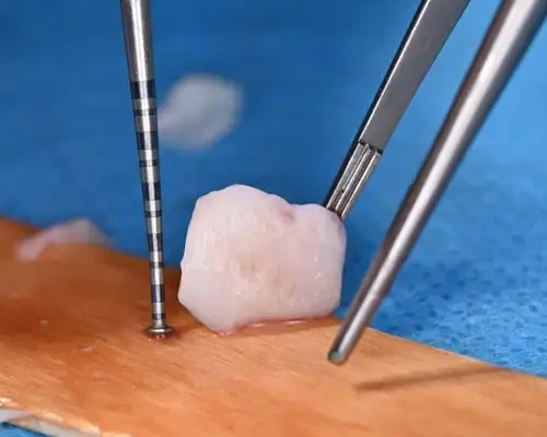 Gum and soft tissue plastic surgery