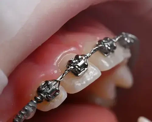 Orthodontics and bite correction in Odessa